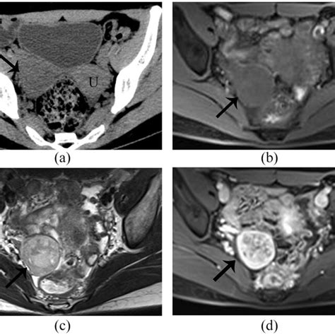 Pdf Imaging Clinical And Pathologic Findings Of Sertoli Leydig Cell