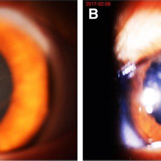 Anterior Segment Photography Of The Patient S Left Eye A The Picture