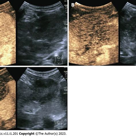 Abdominal Contrast Enhanced Ultrasound A Hepatic Arterial Phase B