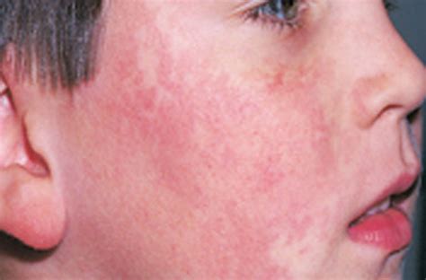 Fifths Disease Rash Pictures Pictures Photos