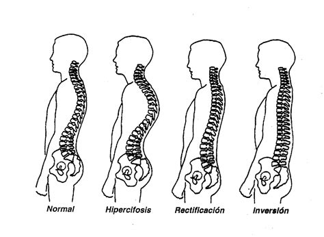 Qu Es La Rectificaci N Dorsal Ejercicios Y Recomendaciones