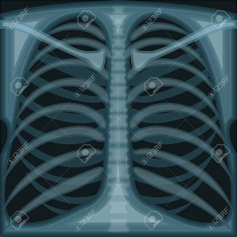 X Ray Clip Art 10 Free Cliparts Download Images On Clipground 2025