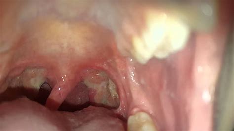 Tonsillectomy Healing Day 10 Youtube