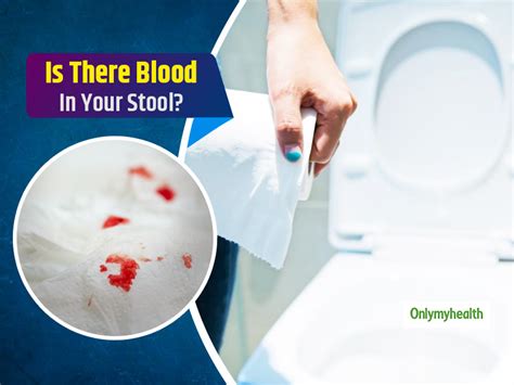 Blood Clots Stool at Mary Greenwell blog