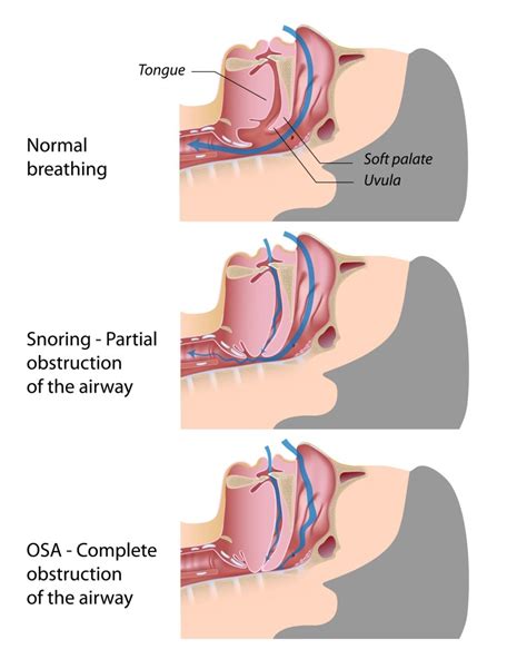 Obstructive Sleep Apnea Osa • Premier Sleep Center