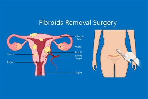 Shrinking Vs Removing Uterine Fibroids What Is Right For You New York City 1 Fibroid Center