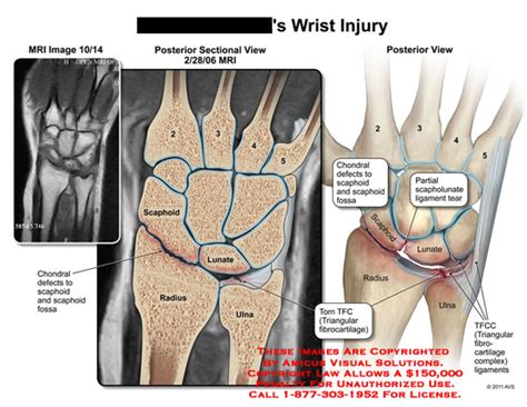 AMICUS Illustration of amicus,injury,wrist,MRI,scaphoid,lunate,radius ...