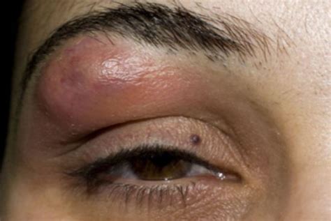 Pimple On Eyebrow Under Between Near Above Swollen Eyelid Get Rid