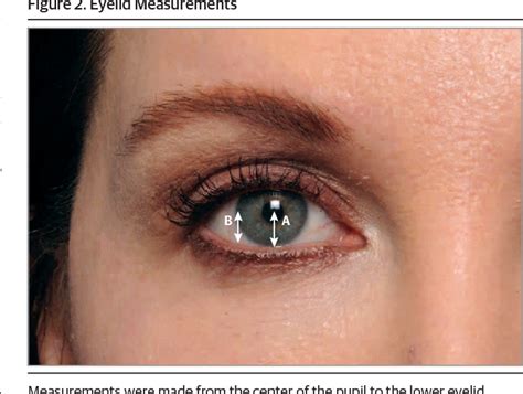 Figure 1 From Measurement Of Change In Lower Eyelid Position In