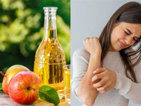 Eczema home remedies: Itching Home Remedies: 8 best home remedies for ...