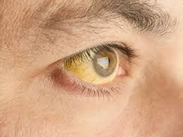 Scleral Icterus - Definition, Causes, Symptoms, Treatment, Vs Jaundice