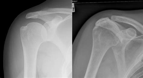 Indiaorthosurgeon Cuff Tear Arthropathy