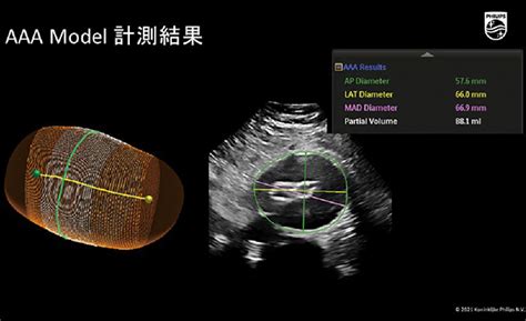 RSNA2021 フィリップス：超音波：幅広い領域でハイパフォーマンスを提供する「EPIQ Elite」