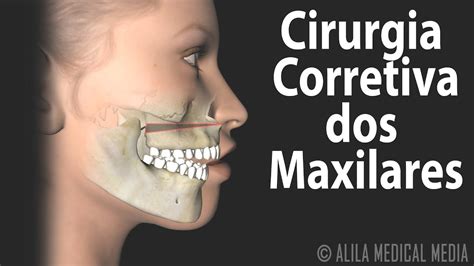 Cirurgia Corretiva dos Maxilares, Animação. Alila Medical Media ...