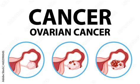 Medical Anatomy Infographic: Woman's Ovarian Cancer Awareness Stock ...