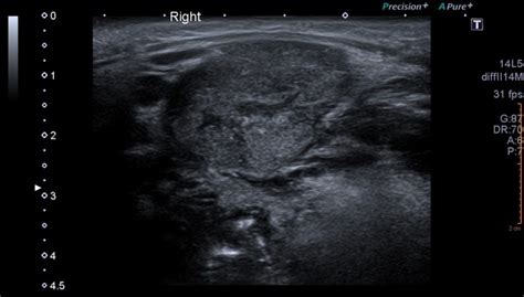 Submandibular Abscess Ultrasound