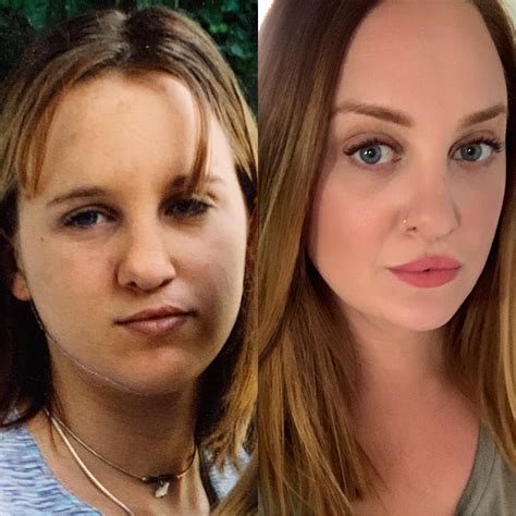 13 vs 35 (taken yesterday). Born with cleft lip and palate, I was