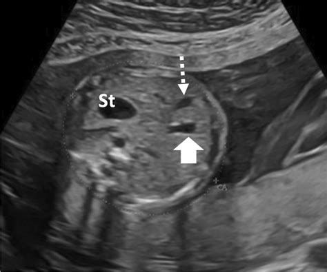 Normal Fetal Gallbladder In The Second Trimester Transverse Us Of The