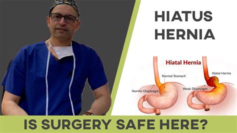 What Kind Of Doctor Does Hiatal Hernia Repair
