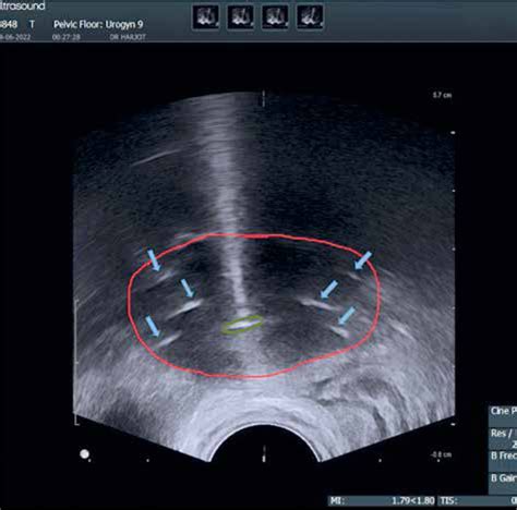 Trans Rectal Ultrasound Guided Hybrid Intra Cavitary And Interstitial Brachytherapy In Carcinoma