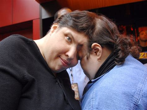 Worlds Oldest Conjoined Twins Lori And George Schappell Dead At 62