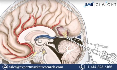 Global Neuroendoscopy Devices Market Size Share Price Trends Growth