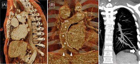 The Volume‐rendered Image A From A Patient With Left Isomerism Shows
