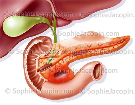 Pathologies Du Pancr As Illustration Medicale Sophie Jacopin