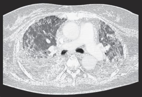 Axial Chest Computed Tomography Scan A Before The First