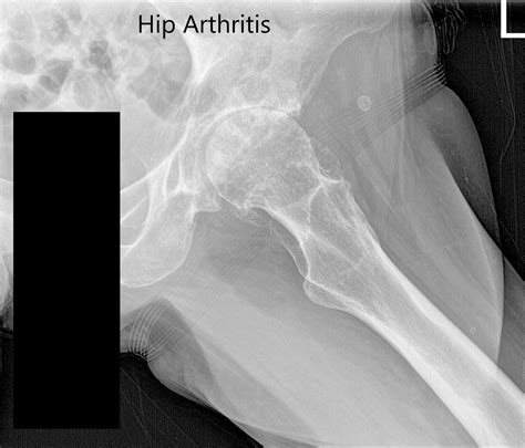 Case Study: Bilateral Total Hip Arthritis in 66 yr. Old Male
