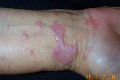 Psoriasis Vs Ringworm