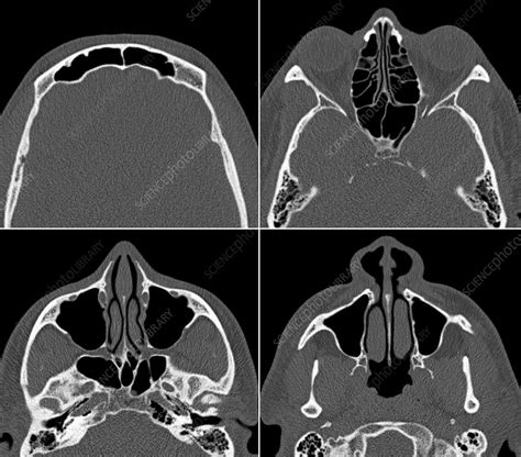 Abnormal Ct Scan Of Sinuses