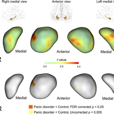 Statistical maps showing the location of shape difference in the ...
