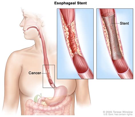 Esophageal Cancer | Thoracic Oncology Program