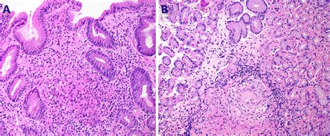 A Crohn’s Disease Of The Stomach The Granulomas Are Epithelioid And Download Scientific