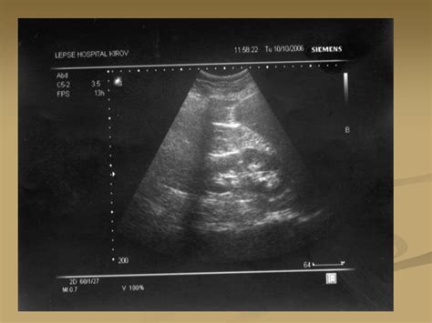 Пиелонефрит - презентация онлайн
