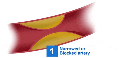 coronary angioplasty  stent implantation raffles heart centre