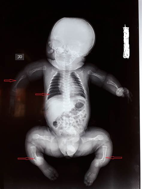 Osteogenesis Imperfecta Type 1