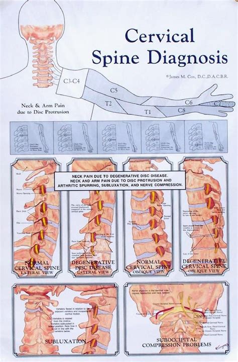 cervical spine diagnosis anatomy poster clinical charts  supplies