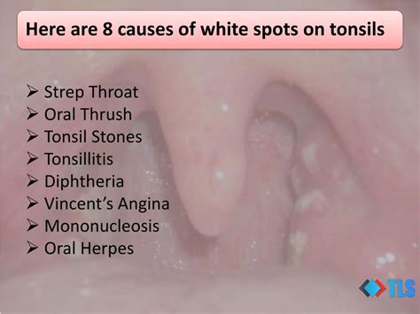 Ppt 8 Causes Of White Spots On Tonsils You May Not Know Powerpoint