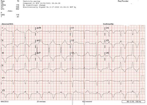 Long Term Outcome Of The First Completely Leadless Cardiac