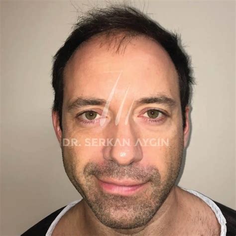 Hair Transplant Turkey Before And After Dr Serkan Aygin Clinic