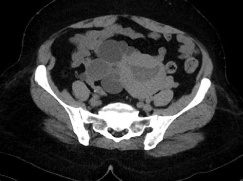 Contrast Enhanced Computed Tomography Of The Pelvis Showing The Uterus