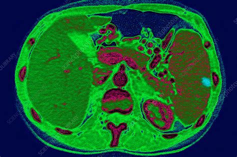 Spleen Infarction Ct Scan Stock Image C0269502 Science Photo Library