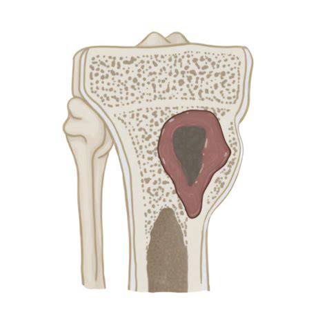 Osteomyelitis Cllc Montréal Dre Marie Gdalevitch