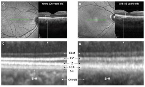 Bruchs Membrane A Key Consideration With Complement Based Therapies