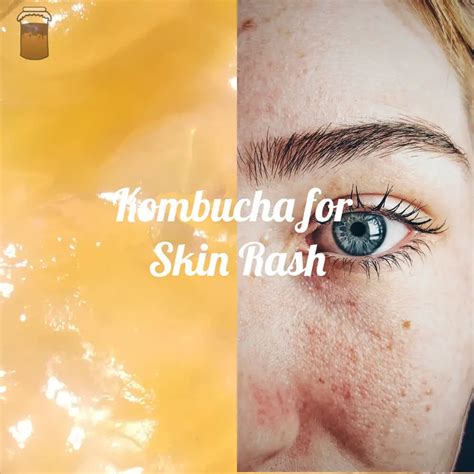 The Effect Of Kombucha On Skin Rash Todo Kombucha