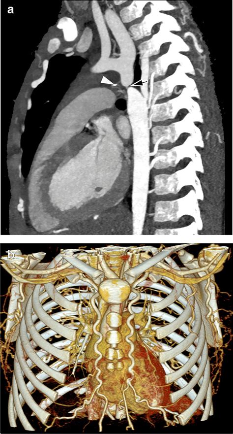 Severe Coarctation Of The Aorta In A 6 Year Old Boy A Sagittal Oblique Download Scientific