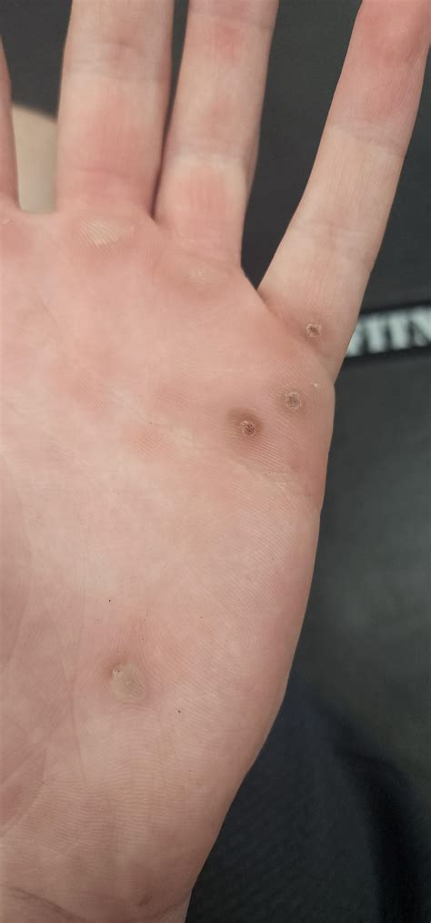 Did the freeze treatment work? : r/Warts