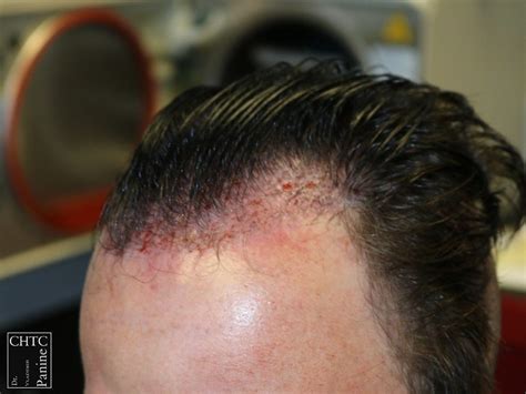 Panine Md Chicago Hair Transplant Clinic Fue Hair Transplant Patient’s Results W 2 500